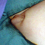 gömük penis