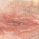 herpes