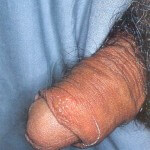 genital ülser - herpes
