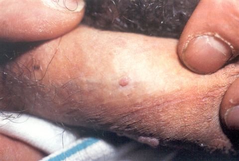 erkeklerde human papilloma virus tedavisi)