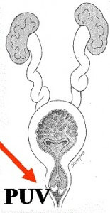 posterior üretral valv