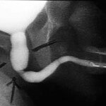 posterior üretral valv