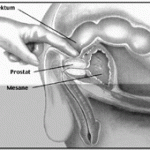 prostatit